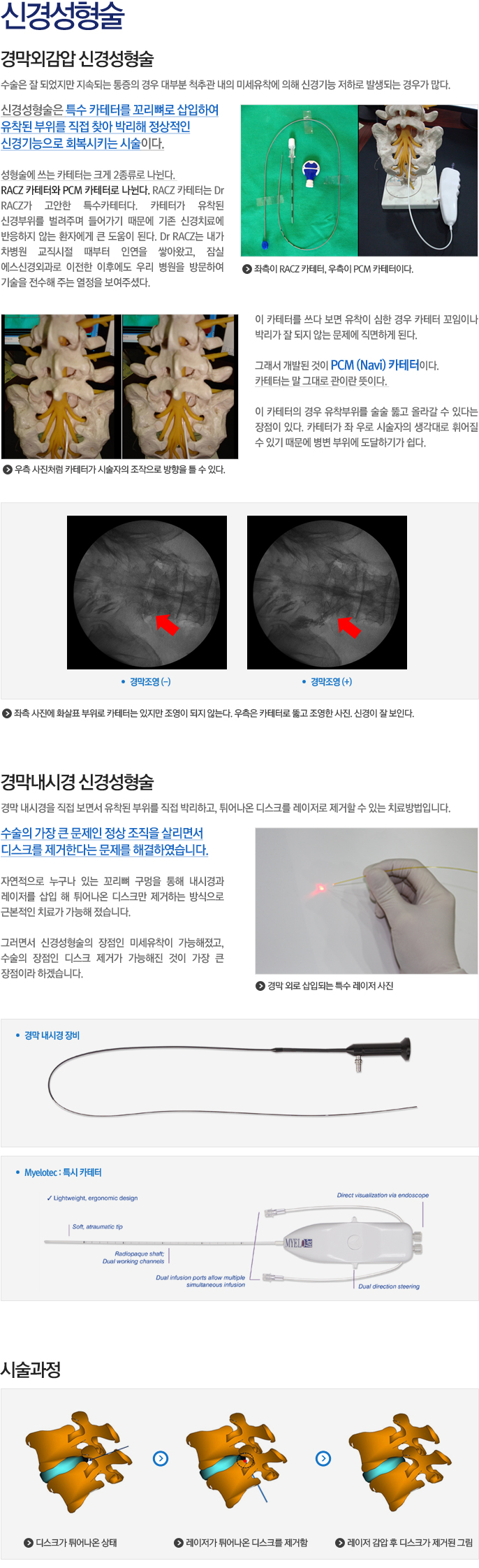 신경성형술